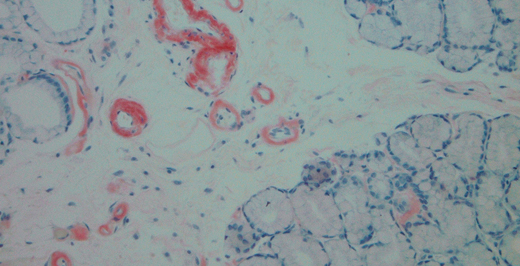 Congo Red Positive Amyloid Deposits in the GI Tract